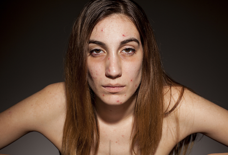 Drug addict suffering from serious weight loss